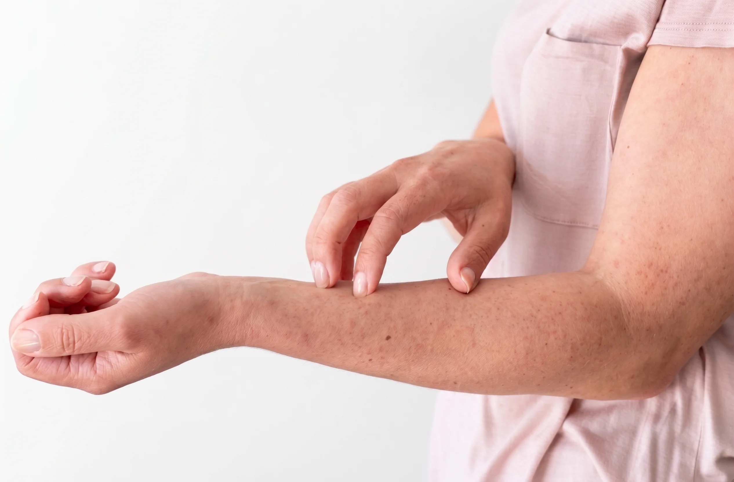 Person scratching arm with visible bed bug bites and skin irritation